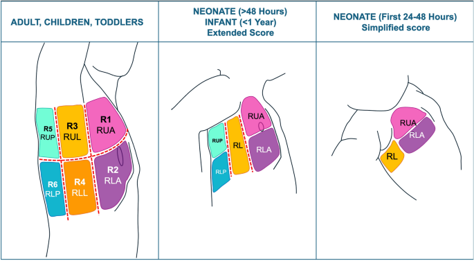 ESICM–ESPNIC International Expert Consensus on Quantitative Lung Ultrasound in Intensive Care